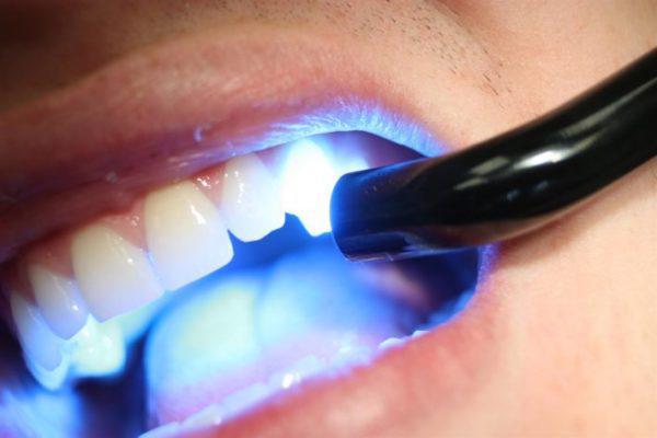 Лазерне відбілювання зубів: плюси і мінуси, відмінності лазерного і фотовідбілювання.
