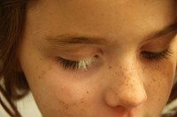 Як лікувати вітіліго у дітей і дорослих: причини і симптоми вітіліго 