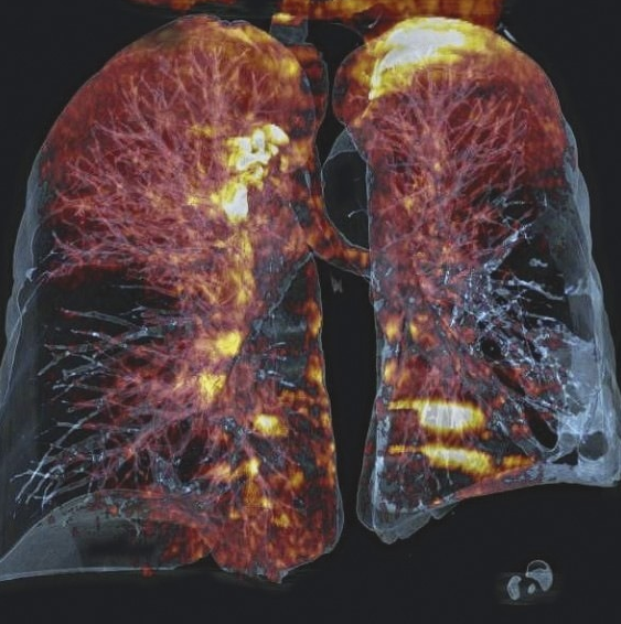 Комп'ютерна томографія легень, суть методу, показання, відносні протипоказання, порівняння зі звичайною рентгенографією