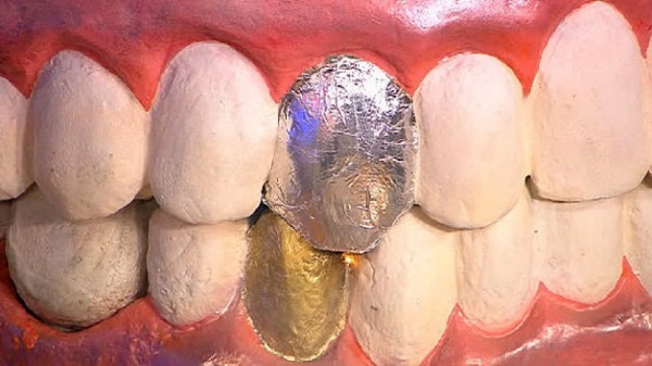 Гальваноз порожнини рота: причини виникнення, супутні симптоми, тактика лікування і профілактика
