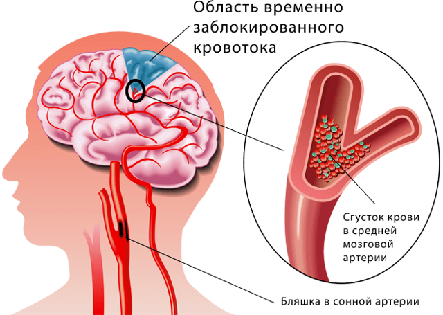 Як лікувати порушення мозкового кровообігу?