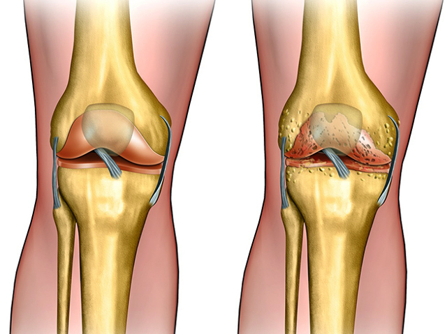 Посттравматичний артроз колінного суглоба: ступеня, симптоми, лікування