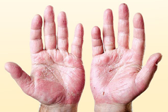 Чим лікувати екзему на руках: долонях, пальцях і кистях?