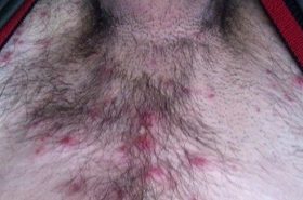 Висип на статевих органах: члені і на статевих губах, чому з'явилася, як діагностуються різні види
