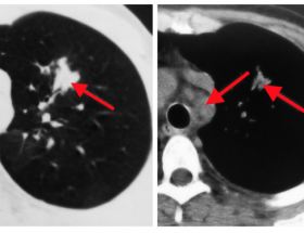 Рентген і комп'ютерна томографія легенів як методи діагностики туберкульозу та інших патологій