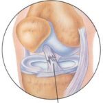 Розрив зв'язок колінного суглоба: симптоми, лікування, реабілітація