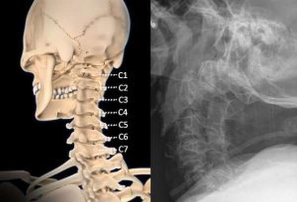 Перелом шийного відділу хребта: характерні ознаки, невідкладна допомога при ушкодженні спинного мозку, методи лікування