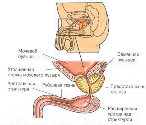 Стриктура уретри: симптоми і лікування звуження сечівника у чоловіків і жінок