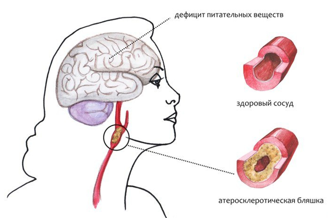 Енцефалопатія головного мозку: що це таке, лікування і наслідки