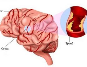 Тромбоемболія судин головного мозку: причини розвитку, характерні ознаки, методи терапії і заходи профілактики