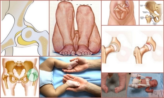 Синостоз тазостегнового суглоба: причини, симптоми, лікування, ризики