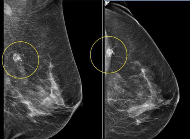 Як розшифрувати результат мамографії