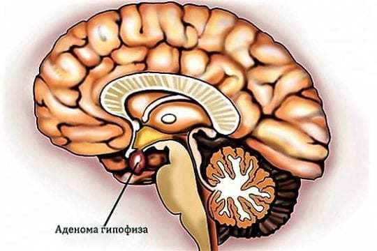 Пухлини гіпофіза - симптоми у жінок і чоловіків, діагностика, лікування.