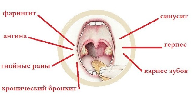 Золотистий стафілокок в горлі: симптоми і лікування у дорослих і дітей