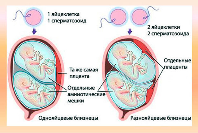 Багатоплідна вагітність: двійні та близнюки, багатоплідна вагітність при ЕКЗ, причини