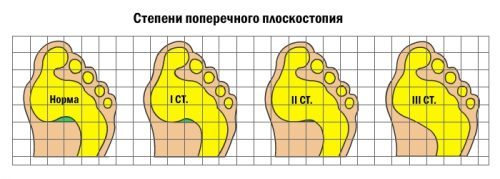 Порожня стопа: що це таке, симптоми і лікування, чи можлива служба в армії