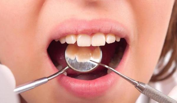 Хімічні пломби для зубів: назви, шкода і користь, термін служби цементів