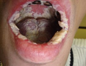 Молочниця в роті: причини виникнення, симптоми і методи лікування орального кандидозу з докладними фото