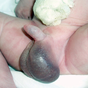 Перекрут яєчка: симптоми, операція при перекруте яєчка у хлопчиків і чоловіків
