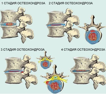 Симптоми остеохондрозу шийного, грудного, поперекового відділів хребта, лікування остеохондрозу