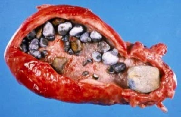Камені підшлункової залози: причини, симптоми, лікування панкреолітіаза