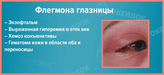 Флегмона очі - причини, симптоми флегмони очниці, століття, слізного мішка, діагностика і лікування