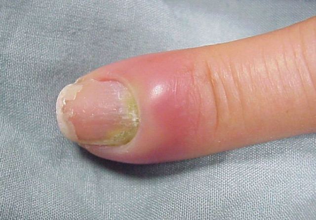 Кістковий панарицій великого пальця кисті: причини, симптоми, лікування