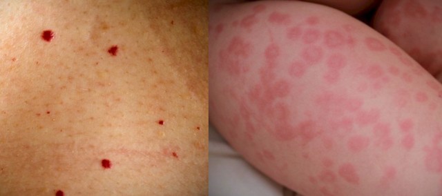 Чому з'являються червоні сверблячі плями на тілі?