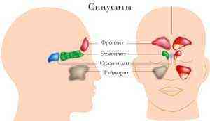 Гіперпластичний риніт, гайморит, синусит і риносинусит: симптоми і лікування