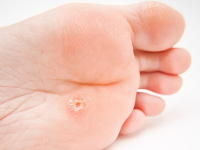 Видалення шіпіци на нозі у дитини: як видалити шіпіцу Саліпод - правила застосування пластиру 