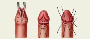 Обрізання крайньої плоті: як виглядає, як і навіщо роблять обрізання у чоловіків