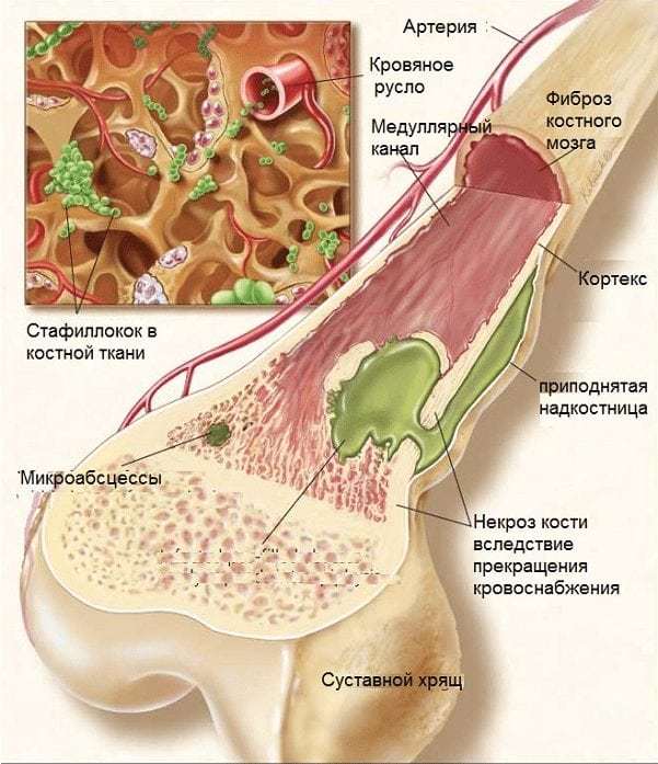 Гнійний артрит колінного, гомілковостопного, тазостегнового і плечового суглоба: лікування