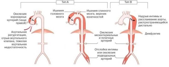 Розшарування аорти: перша допомога, симптоми, причини, методи діагностики і лікування