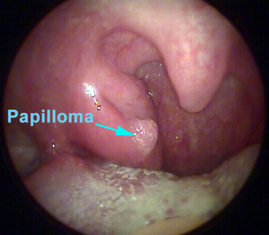 Папіломатоз гортані: причини, симптоми і лікування