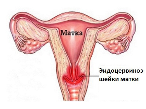 Ендоцервікоз - патологія шийки матки