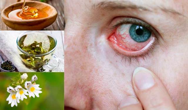 Грибок очей: симптом і лікування грибкового захворювання на століттях очей, фото