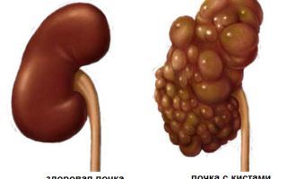Полікістоз нирок: симптоми, лікування, дієта і народні засоби при поликистозе нирок