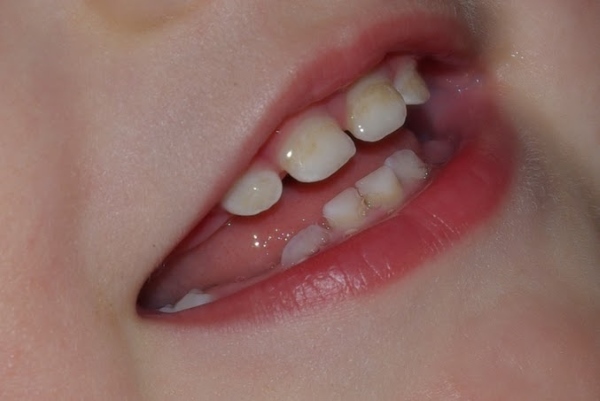Плями на зубах - білі, жовті, коричневі, чорні: причини і лікування