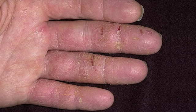 Чим лікувати екзему на руках: долонях, пальцях і кистях?