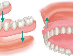 Бюгельні протези для зубів: як правильно вибрати на верхню і нижню щелепу