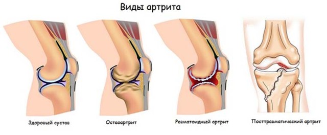 Запалення зв'язок колінного суглоба: причини, як виникає, симптоми і лікування