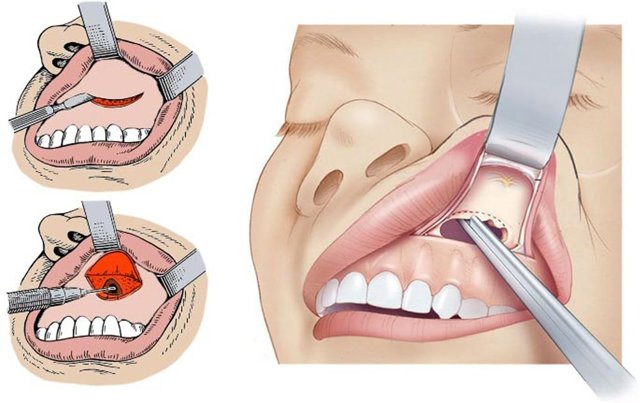 Операція при гаймориті: як роблять чистку пазух носа?