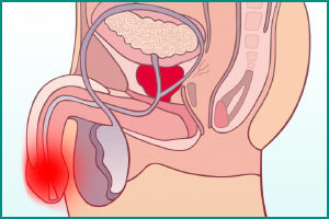 Болі при сечовипусканні у чоловіків - причини болю, різей при сечовипусканні