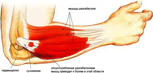 Біль в ліктьовому суглобі з внутрішньої сторони руки: причини, діагностика та лікування