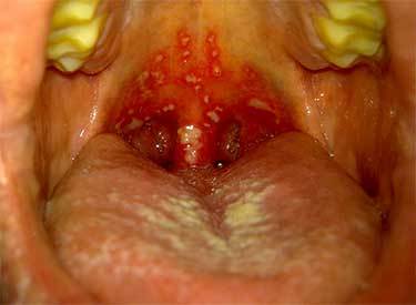 Герпес в горлі у дитини і дорослого: як лікувати, причини і симптоми