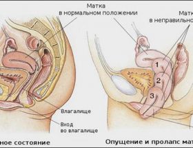 Можна з однієї причини визначити опущення матки?