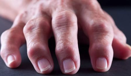 Болять суглоби рук і ніг: що робити, причини і лікування, народні засоби