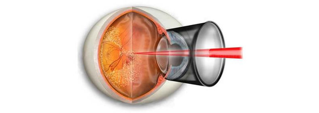 Макулодистрофія сітківки ока: причини, лікування, профілактика