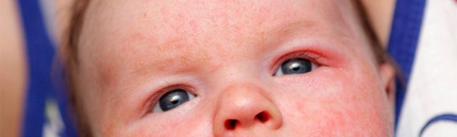 Чому у дитини з'явилися червоні плями на тілі?