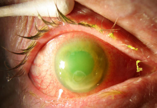 Опік рогівки ока: лікування, симптоми, наслідки, які краплі використовувати